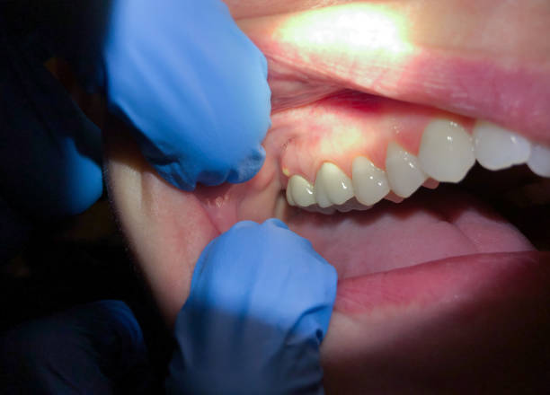 Best Cracked Tooth Emergency Dentist  in Llender, CA