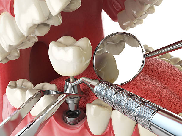 Best Urgent Tooth Repair  in Llender, CA